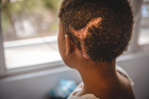 Port-au-Prince, Haiti, Monday, June 21, 2022.
  This unaccompanied minor suffered a gunshot wound to the head. At the moment, it is very difficult for MSF to find a foster care facility for this child after his treatment, he is still staying at the MSF emergency center in Turgeau.
MSF is also seeing a slight increase in unaccompanied patients.
  MSF/Johnson Sabin
