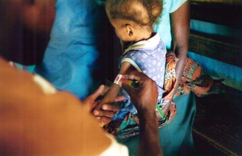 Mesure du perimetre brachial (rouge)avec un MUAC.

 En fevrier 2002, les equipes MSF a Kaala sont alertees par un nombre important d'enfants malnutris venant de Bunjei (110 km au sud de Kaala), une zone inaccessible depuis 1998, amenes par des camions militaires et civils au CNT de Kaala. Pour faire face a l'afflux de ces enfants arrivant dans un etat critique, deux nouveaux CNT sont ouverts.  Fin mars, MSF obtient enfin l'autorisation de se deplacer a Bunjei. Jusqu'en juin, les equipes mobiles circulent dans les municipios (communes) de Bunjei, Chilembo, Chipindo, Galangue, Sambo et Bailundo, vaccinent contre la rougeole et evacuent les mal nourris et malades severes sur Kaala, Bailundo ou Huambo. Au pic de la crise, il y aura plus de 1 200 enfants dans les CNT de Kaala et 800 a Bailundo. Toutes sections confondues, MSF a ouvert 23 CNT pendant l'epoque de la grande crise et a soigne plus de 17 000 enfants severement mal nourris a travers l'Angola.