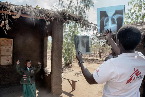 Gloria Chipasula (Left), 11 years old, HIV and TB positive patient, stands outside her family house as MSF international staff doctor from Rwanda checks her X-Ray looking for TB evidences.